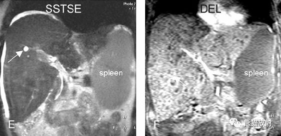 肝硬化之肝细胞癌(HCC)丨多发、肝包膜回缩、弥漫性肝癌、肝内胆管扩张 肝硬化之肝细胞癌(HCC)丨多发、肝包膜回缩、弥漫性肝癌、肝内胆管扩张