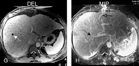 肝硬化之肝细胞癌(HCC)丨多发、肝包膜回缩、弥漫性肝癌、肝内胆管扩张 肝硬化之肝细胞癌(HCC)丨多发、肝包膜回缩、弥漫性肝癌、肝内胆管扩张