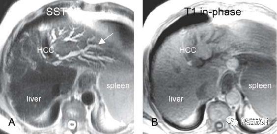 肝硬化之肝细胞癌(HCC)丨多发、肝包膜回缩、弥漫性肝癌、肝内胆管扩张 肝硬化之肝细胞癌(HCC)丨多发、肝包膜回缩、弥漫性肝癌、肝内胆管扩张