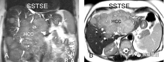 肝硬化之肝细胞癌(HCC)丨多发、肝包膜回缩、弥漫性肝癌、肝内胆管扩张 肝硬化之肝细胞癌(HCC)丨多发、肝包膜回缩、弥漫性肝癌、肝内胆管扩张