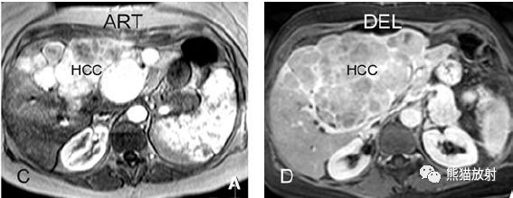 肝硬化之肝细胞癌(HCC)丨多发、肝包膜回缩、弥漫性肝癌、肝内胆管扩张 肝硬化之肝细胞癌(HCC)丨多发、肝包膜回缩、弥漫性肝癌、肝内胆管扩张
