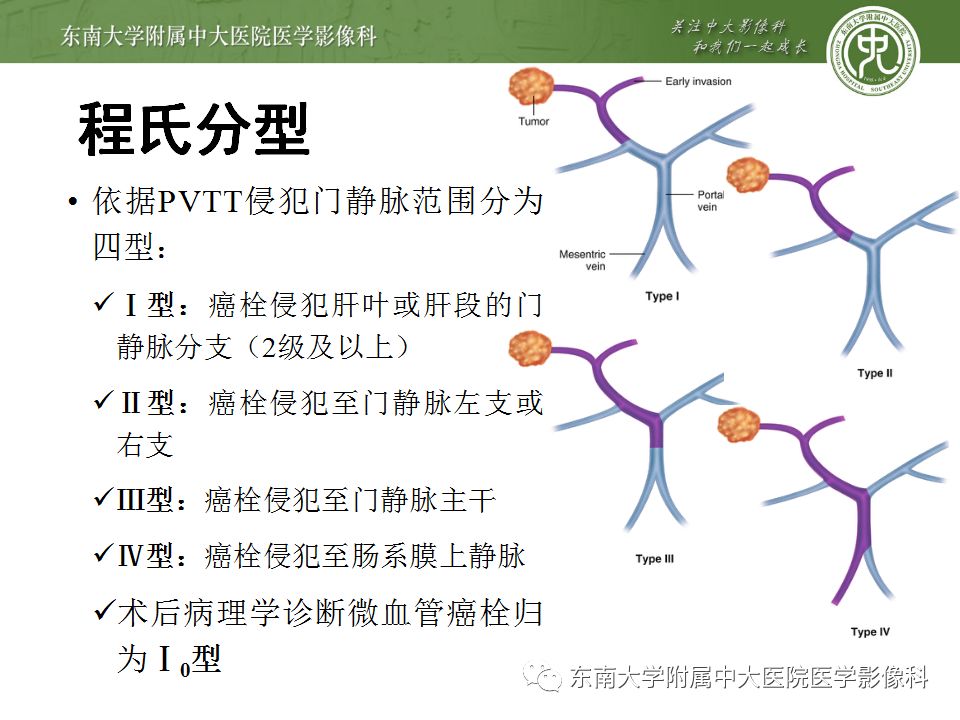 【病例】透明细胞型肝细胞肝癌伴脂肪变性及门静脉癌栓1例CT