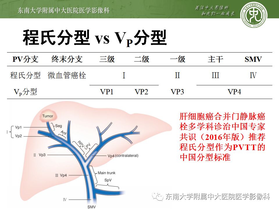 【病例】透明细胞型肝细胞肝癌伴脂肪变性及门静脉癌栓1例CT