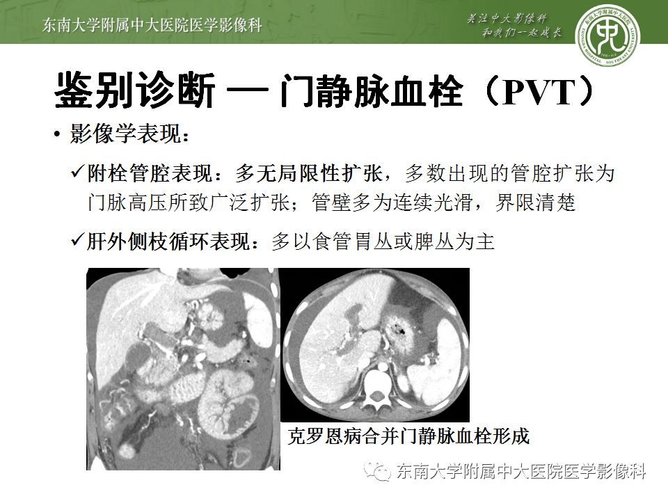 【病例】透明细胞型肝细胞肝癌伴脂肪变性及门静脉癌栓1例CT