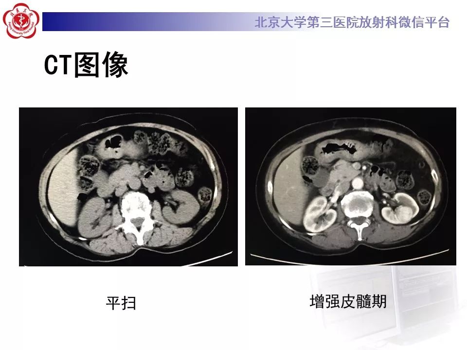 【病例】肾嗜酸细胞腺瘤1例CT影像诊断