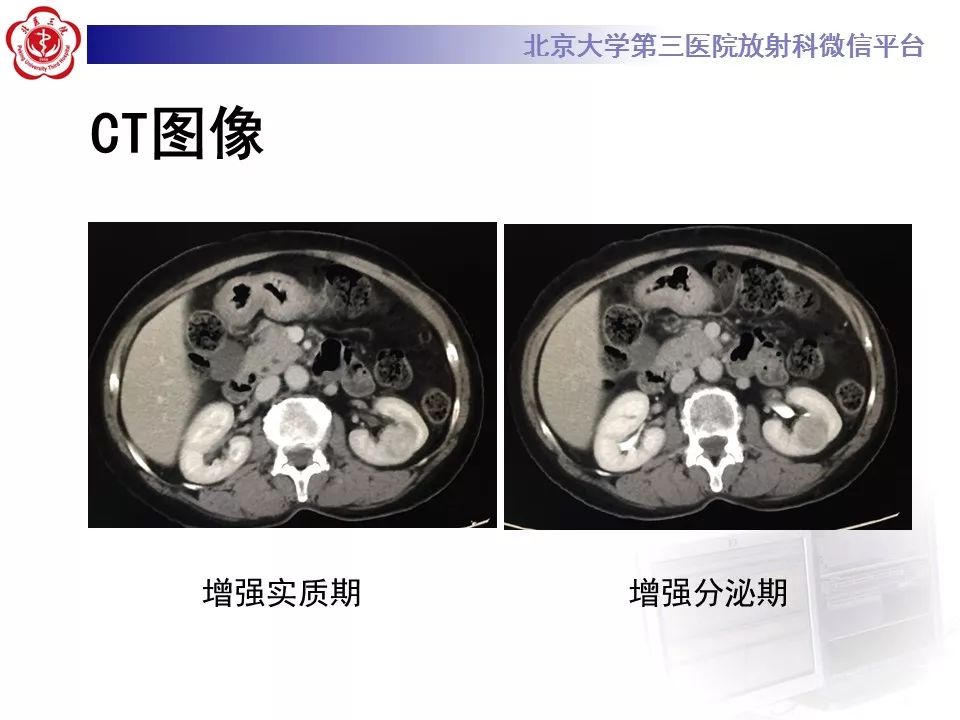 【病例】肾嗜酸细胞腺瘤1例CT影像诊断