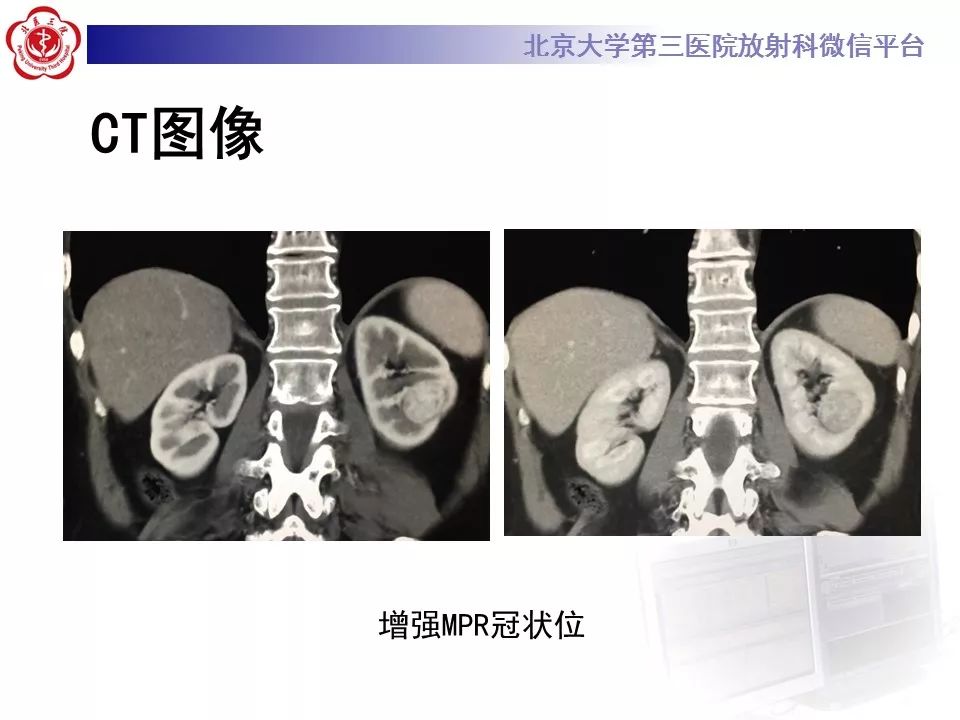 【病例】肾嗜酸细胞腺瘤1例CT影像诊断