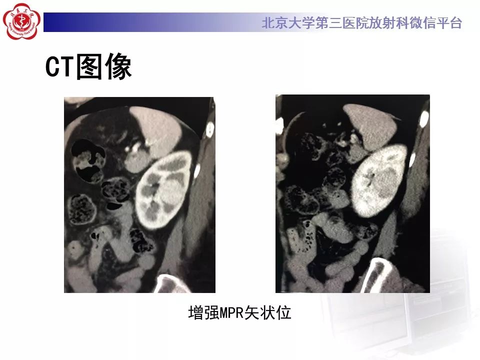 【病例】肾嗜酸细胞腺瘤1例CT影像诊断