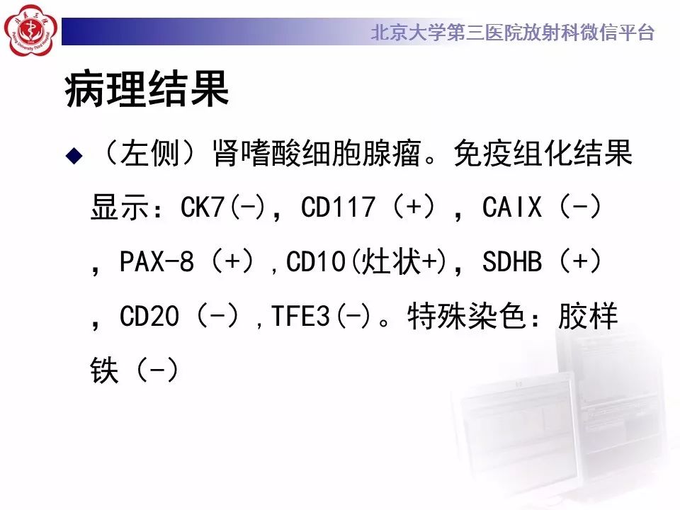 【病例】肾嗜酸细胞腺瘤1例CT影像诊断