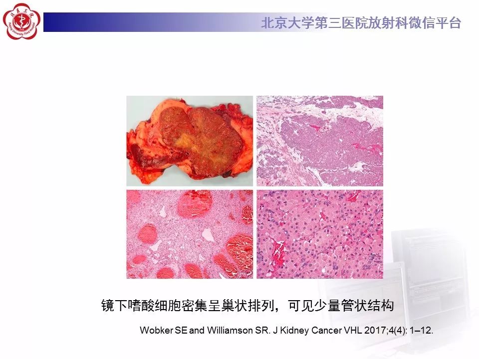 【病例】肾嗜酸细胞腺瘤1例CT影像诊断