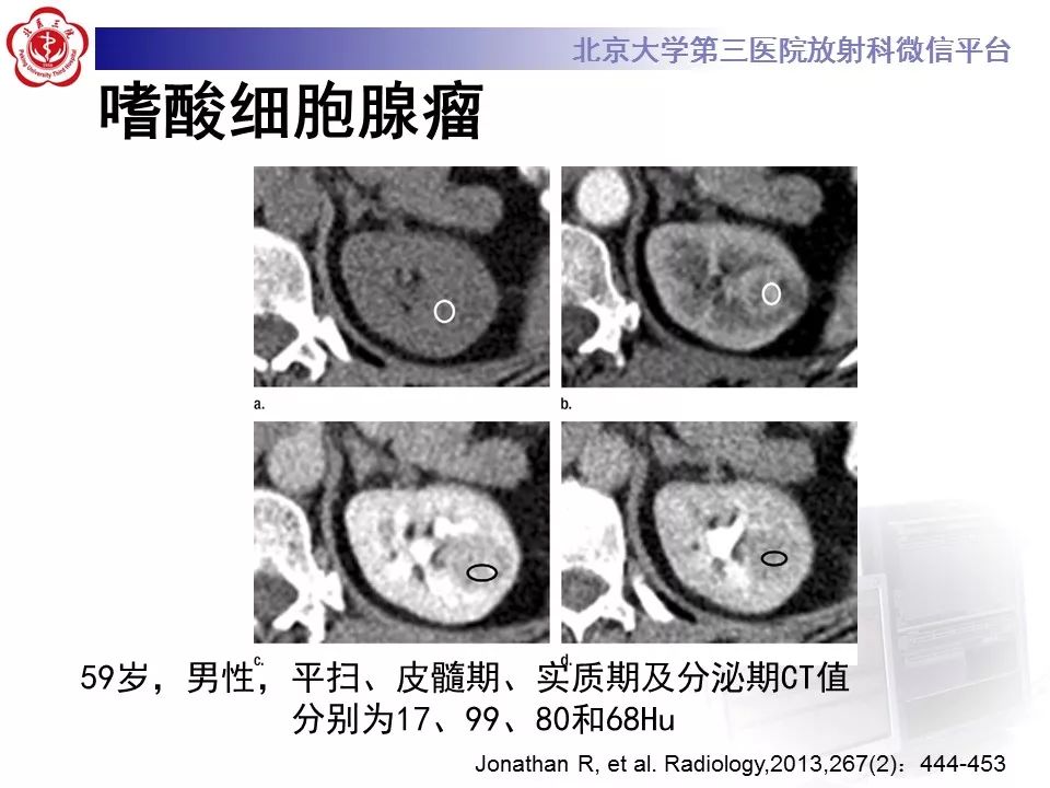 【病例】肾嗜酸细胞腺瘤1例CT影像诊断
