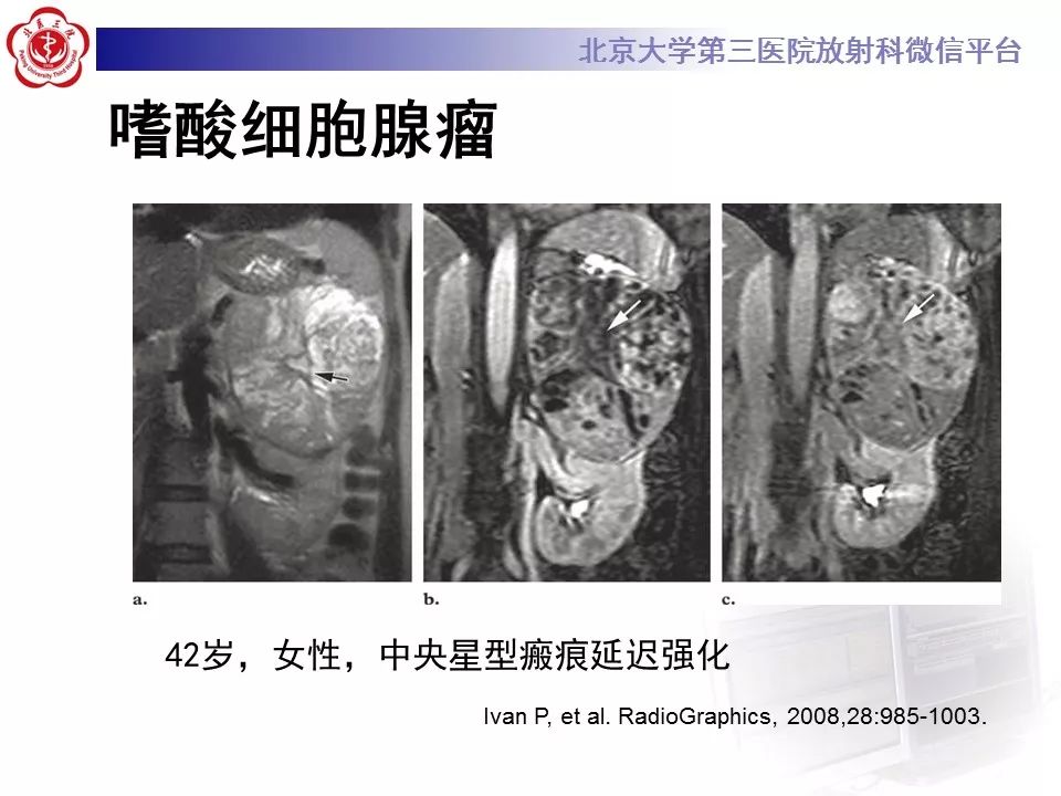 【病例】肾嗜酸细胞腺瘤1例CT影像诊断