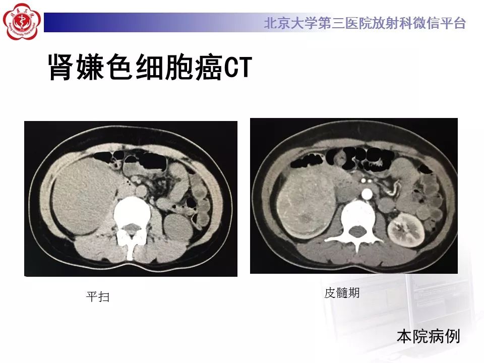 【病例】肾嗜酸细胞腺瘤1例CT影像诊断