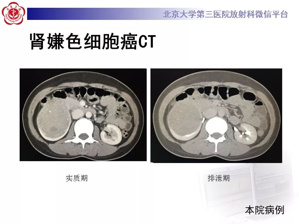 【病例】肾嗜酸细胞腺瘤1例CT影像诊断