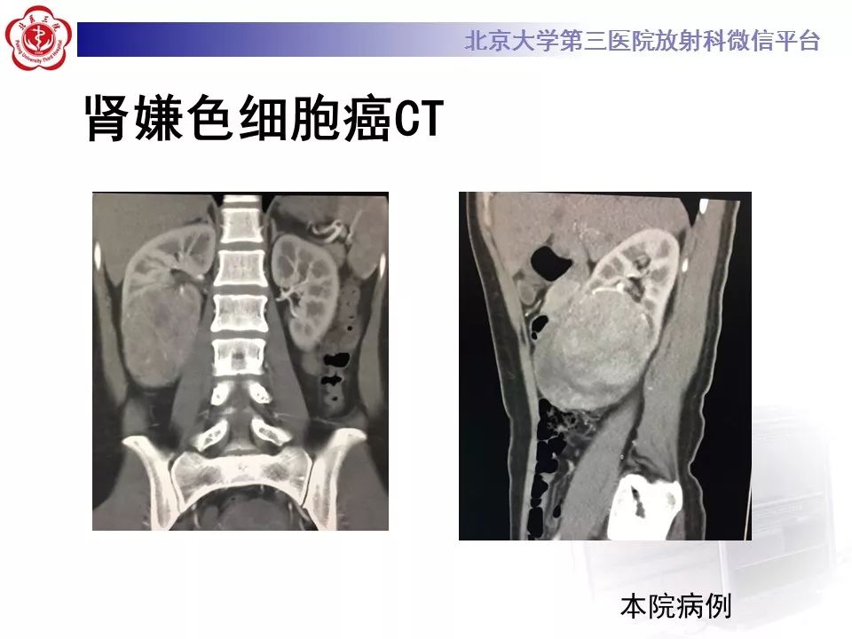 【病例】肾嗜酸细胞腺瘤1例CT影像诊断