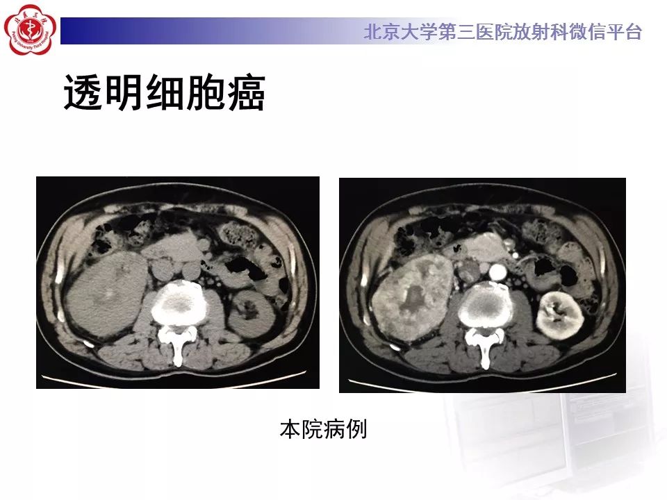 【病例】肾嗜酸细胞腺瘤1例CT影像诊断