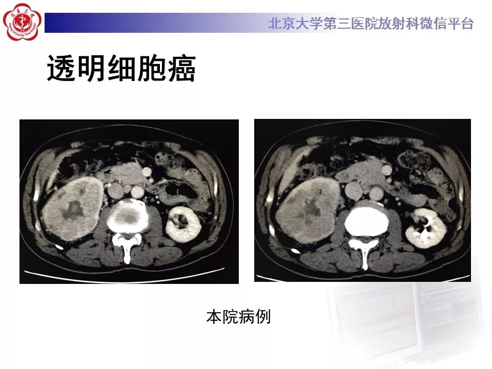 【病例】肾嗜酸细胞腺瘤1例CT影像诊断