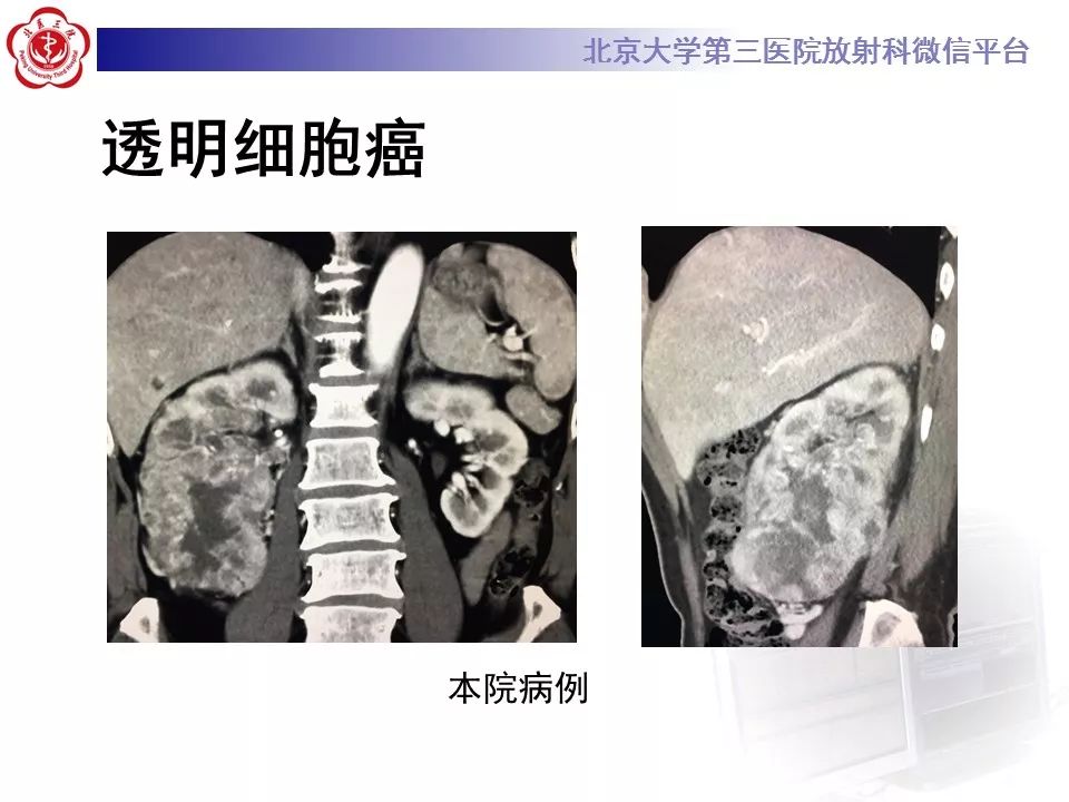 【病例】肾嗜酸细胞腺瘤1例CT影像诊断