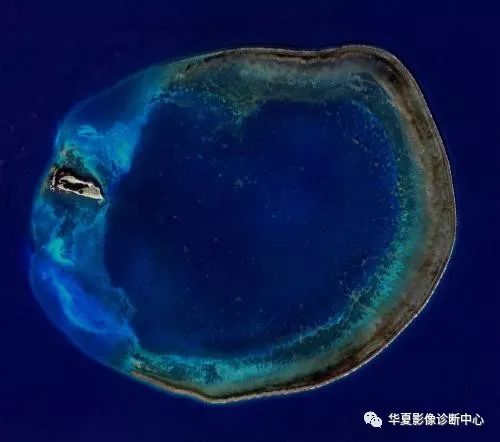 肺部CT反晕征(环礁征)的影像学意义 肺部CT反晕征(环礁征)的影像学意义