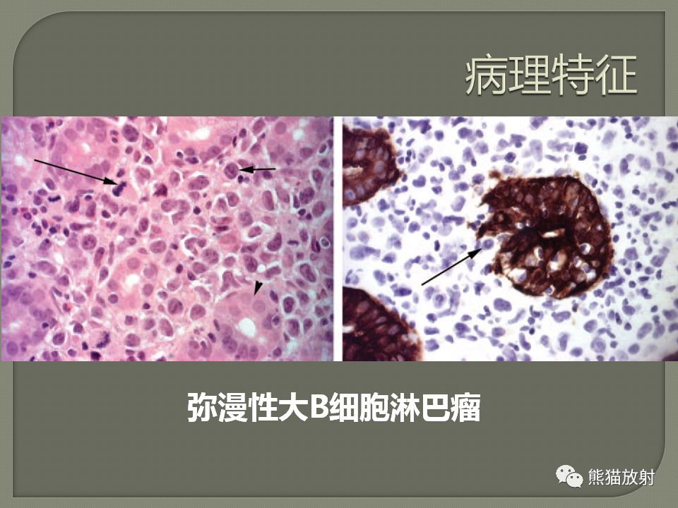 【PPT】原发性胃肠道淋巴瘤的影像诊断及鉴别诊断