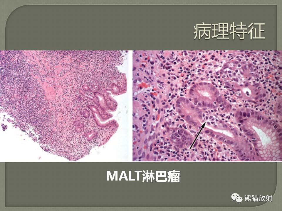 【PPT】原发性胃肠道淋巴瘤的影像诊断及鉴别诊断