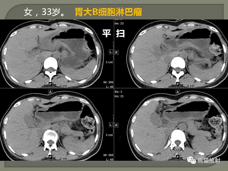 【PPT】原发性胃肠道淋巴瘤的影像诊断及鉴别诊断
