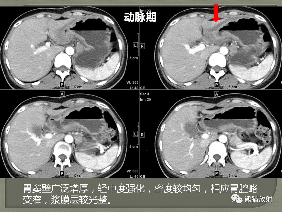 【PPT】原发性胃肠道淋巴瘤的影像诊断及鉴别诊断