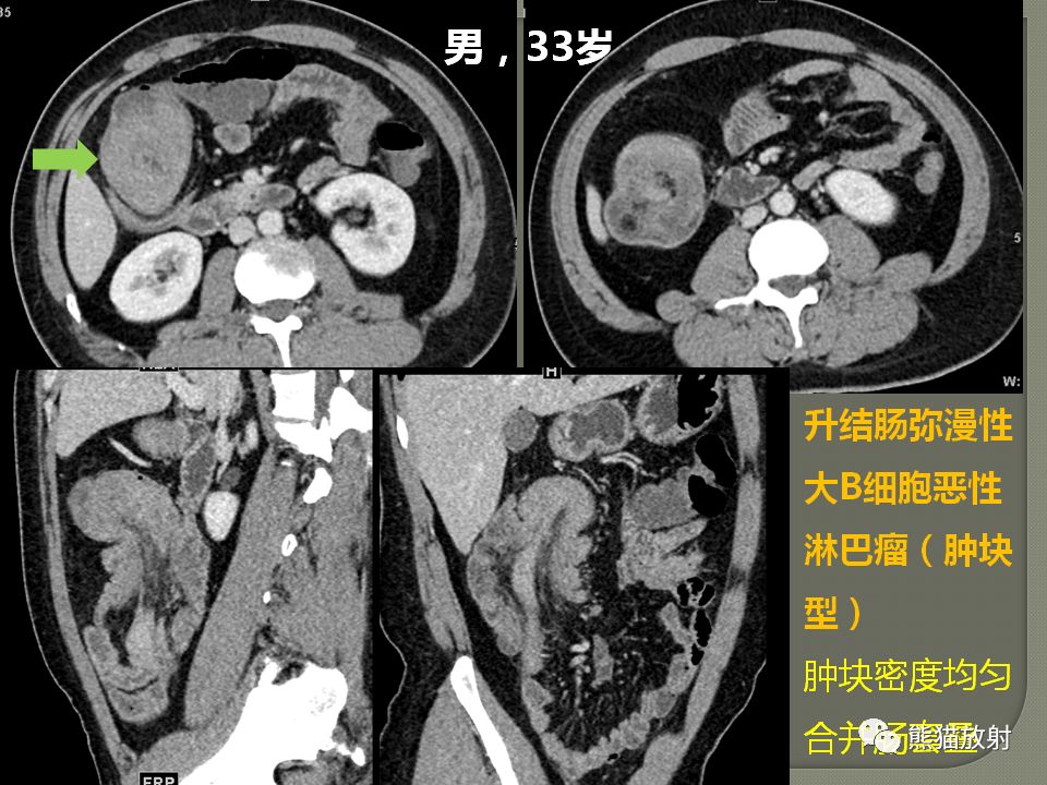 【PPT】原发性胃肠道淋巴瘤的影像诊断及鉴别诊断