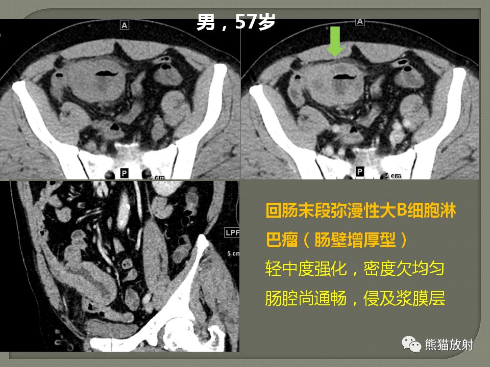 【PPT】原发性胃肠道淋巴瘤的影像诊断及鉴别诊断