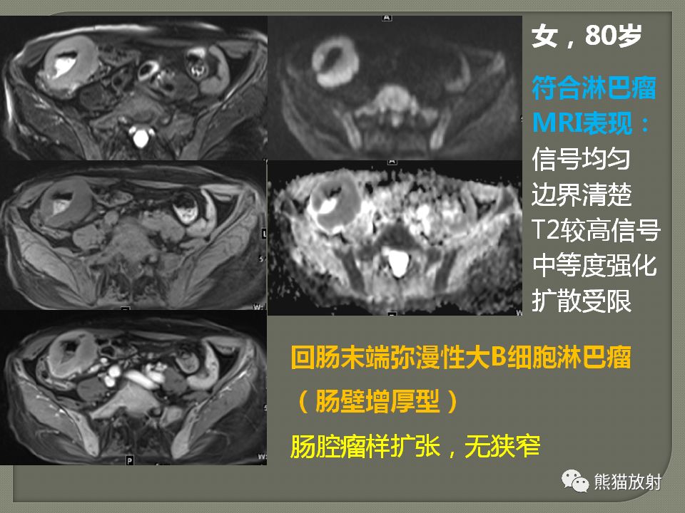 【PPT】原发性胃肠道淋巴瘤的影像诊断及鉴别诊断