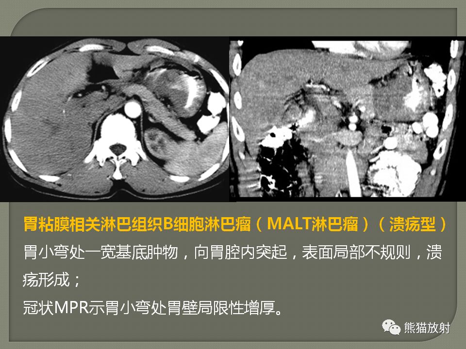 【PPT】原发性胃肠道淋巴瘤的影像诊断及鉴别诊断