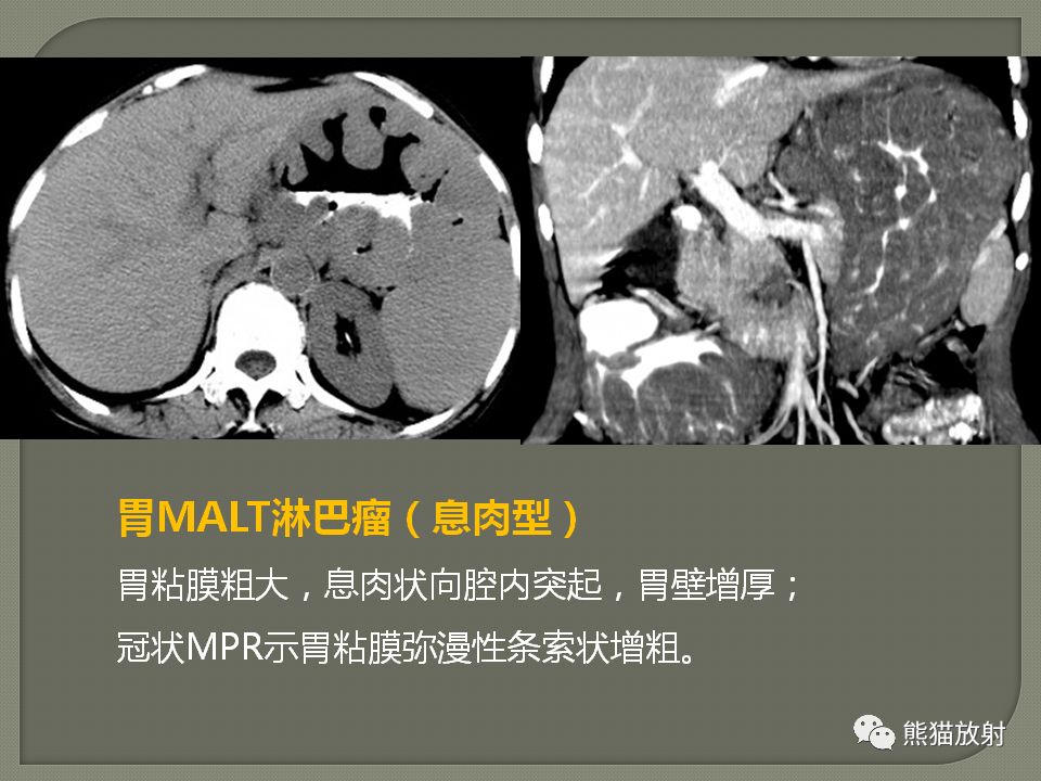 【PPT】原发性胃肠道淋巴瘤的影像诊断及鉴别诊断