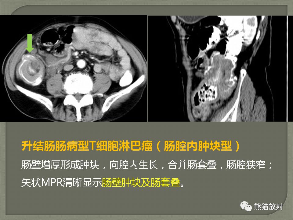 【PPT】原发性胃肠道淋巴瘤的影像诊断及鉴别诊断