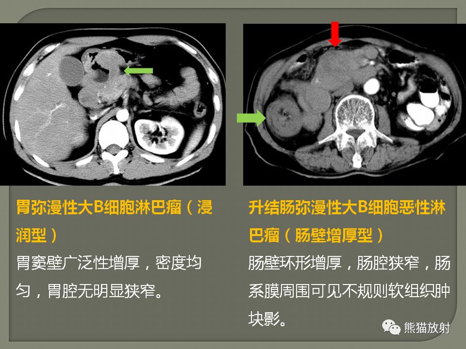【PPT】原发性胃肠道淋巴瘤的影像诊断及鉴别诊断