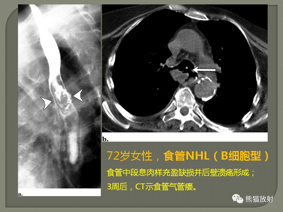 【PPT】原发性胃肠道淋巴瘤的影像诊断及鉴别诊断