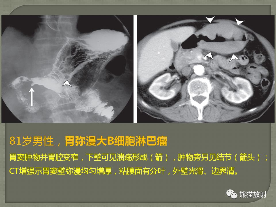 【PPT】原发性胃肠道淋巴瘤的影像诊断及鉴别诊断