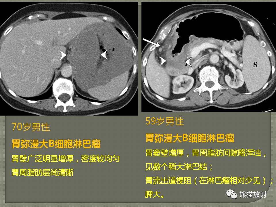 【PPT】原发性胃肠道淋巴瘤的影像诊断及鉴别诊断