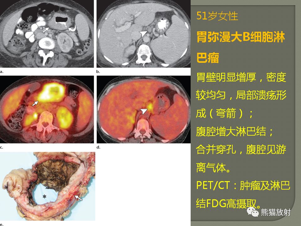【PPT】原发性胃肠道淋巴瘤的影像诊断及鉴别诊断