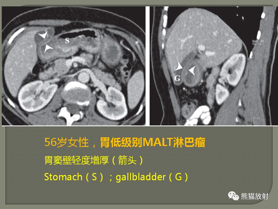 【PPT】原发性胃肠道淋巴瘤的影像诊断及鉴别诊断