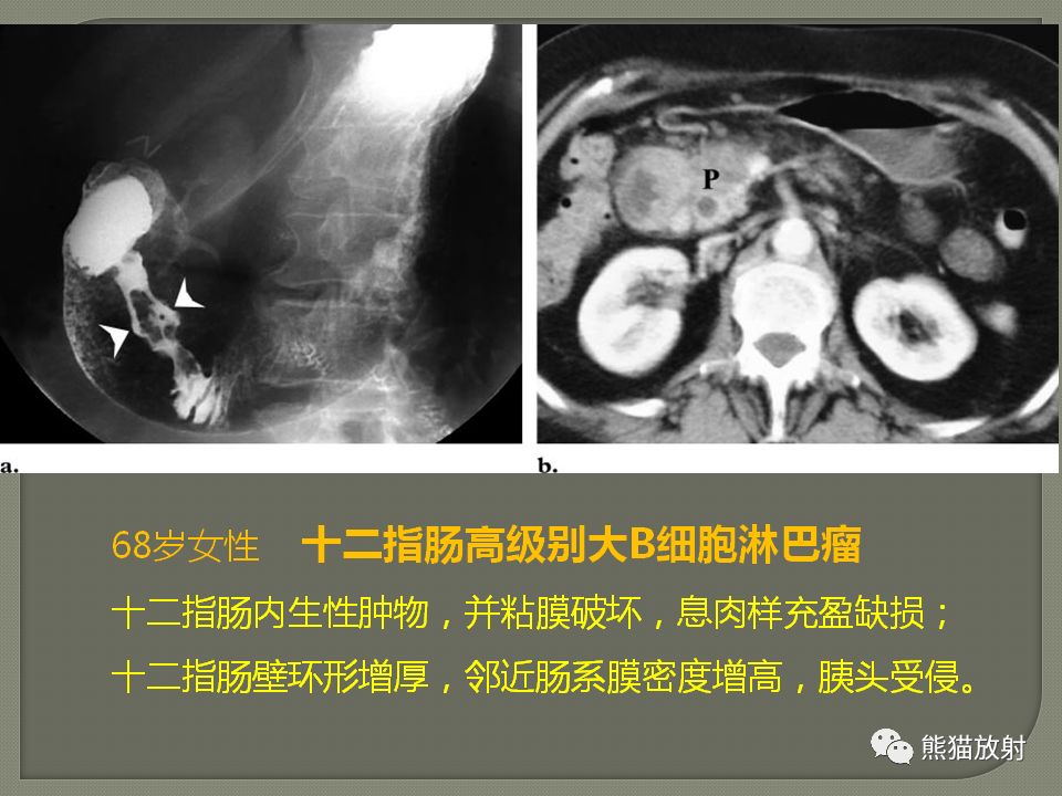 【PPT】原发性胃肠道淋巴瘤的影像诊断及鉴别诊断