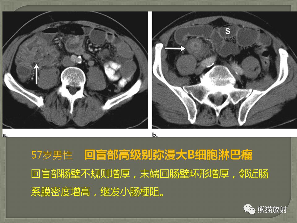 【PPT】原发性胃肠道淋巴瘤的影像诊断及鉴别诊断