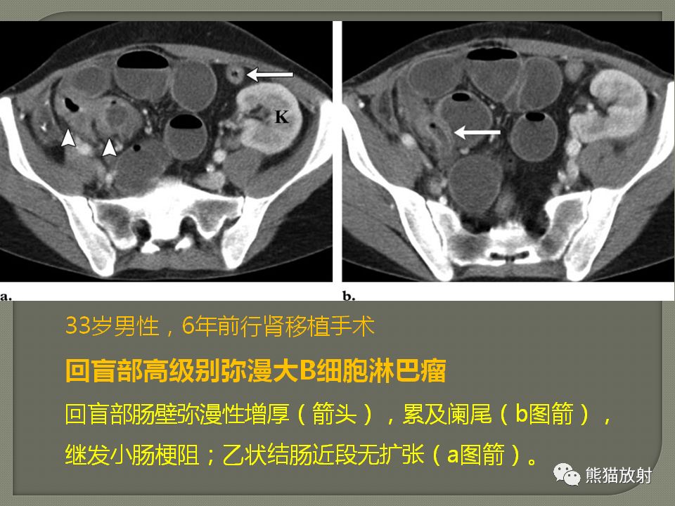 【PPT】原发性胃肠道淋巴瘤的影像诊断及鉴别诊断