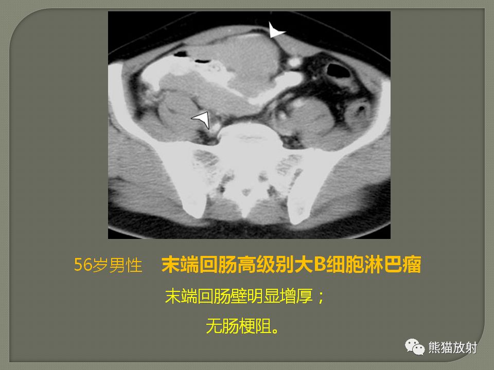 【PPT】原发性胃肠道淋巴瘤的影像诊断及鉴别诊断