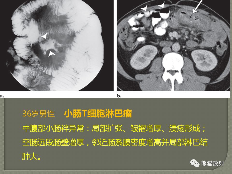 【PPT】原发性胃肠道淋巴瘤的影像诊断及鉴别诊断