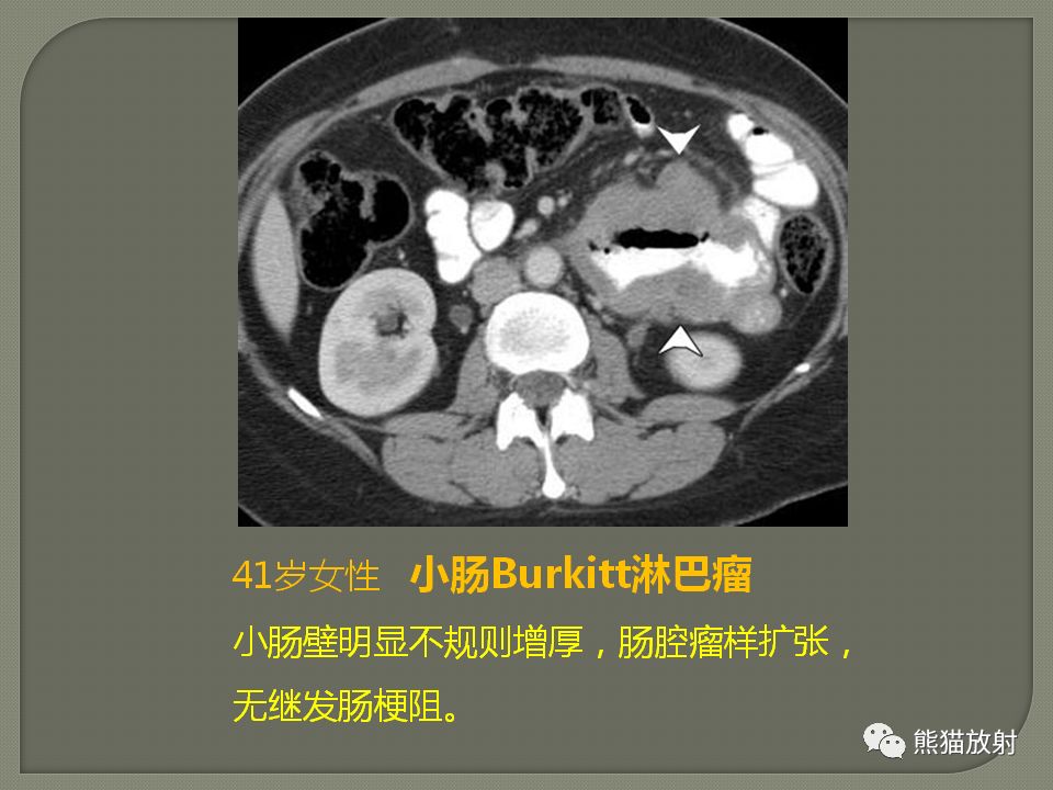 【PPT】原发性胃肠道淋巴瘤的影像诊断及鉴别诊断