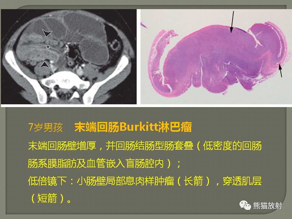 【PPT】原发性胃肠道淋巴瘤的影像诊断及鉴别诊断