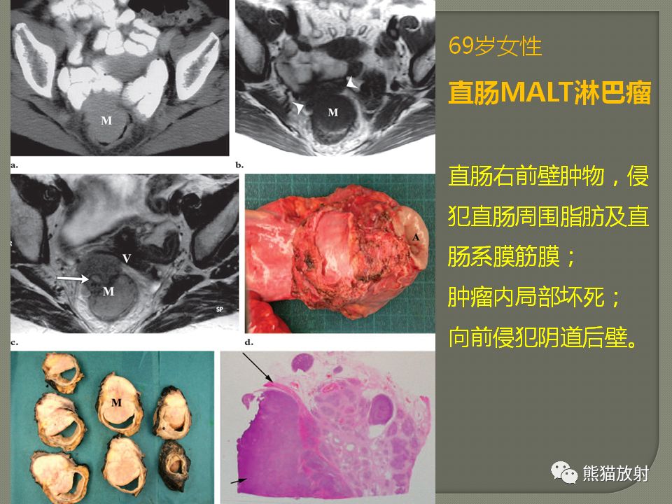 【PPT】原发性胃肠道淋巴瘤的影像诊断及鉴别诊断