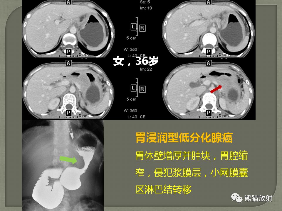 【PPT】原发性胃肠道淋巴瘤的影像诊断及鉴别诊断