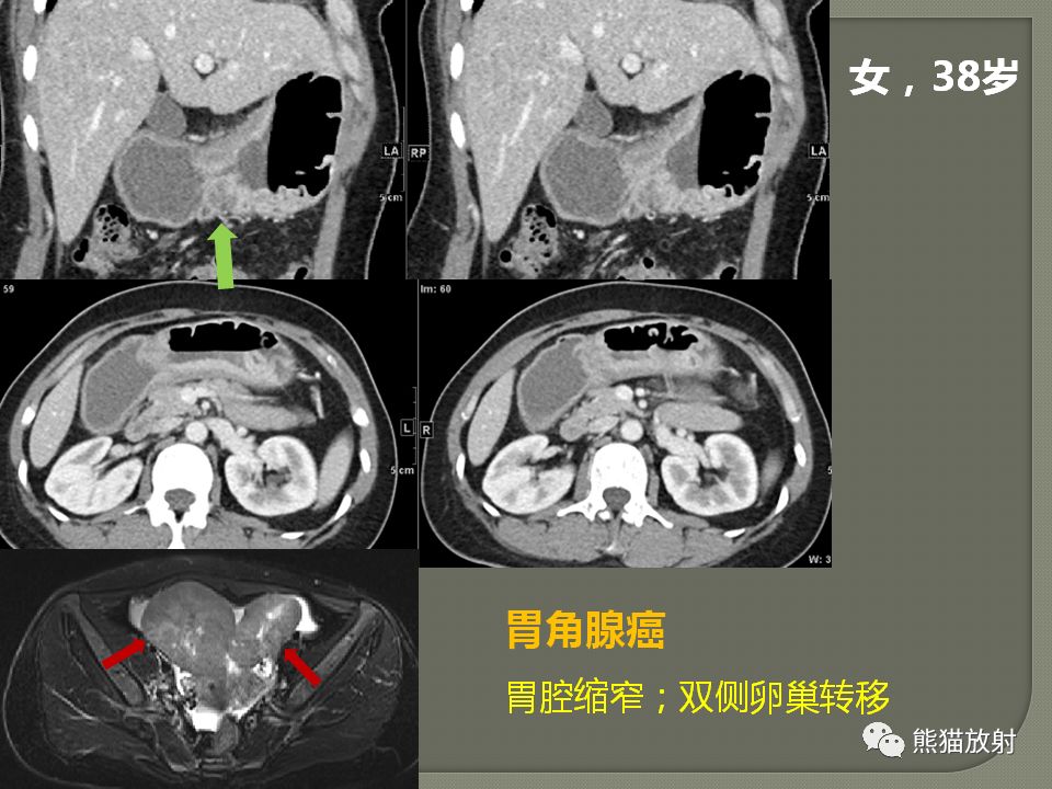 【PPT】原发性胃肠道淋巴瘤的影像诊断及鉴别诊断
