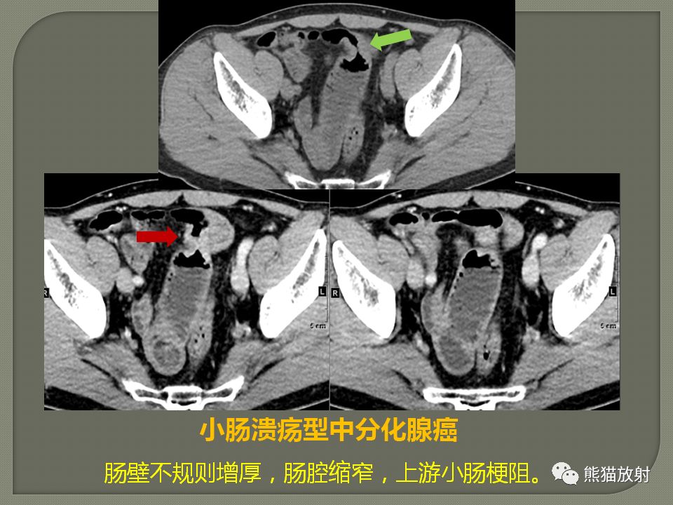 【PPT】原发性胃肠道淋巴瘤的影像诊断及鉴别诊断